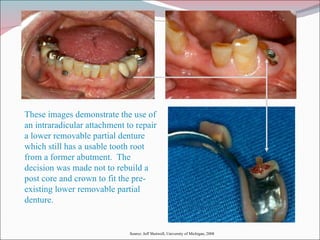 These images demonstrate the use of an intraradicular attachment to repair a lower removable partial denture which still has a usable tooth root from a former abutment.  The decision was made not to rebuild a post core and crown to fit the pre-existing lower removable partial denture. Source: Jeff Shotwell, University of Michigan, 2008 
