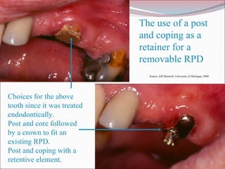 The use of a post and coping as a retainer for a removable RPD Choices for the above tooth since it was treated endodontically.  Post and core followed by a crown to fit an existing RPD.  Post and coping with a retentive element. Source: Jeff Shotwell, University of Michigan, 2008 