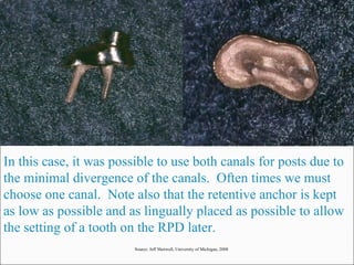 In this case, it was possible to use both canals for posts due to the minimal divergence of the canals.  Often times we must choose one canal.  Note also that the retentive anchor is kept as low as possible and as lingually placed as possible to allow the setting of a tooth on the RPD later. Source: Jeff Shotwell, University of Michigan, 2008 