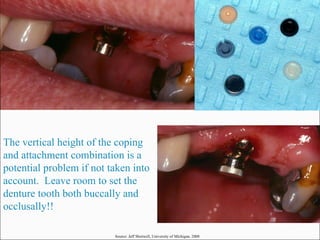 The vertical height of the coping and attachment combination is a potential problem if not taken into account.  Leave room to set the denture tooth both buccally and occlusally!! Source: Jeff Shotwell, University of Michigan, 2008 