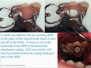 A tooth was added to the pre-existing RPD in the place of the natural tooth which is now cut off at the FGM.  A recess is cut in the underside of the RPD to fit around the attachment coping.  Self cure acrylic will now be painted around the coping making it part of the RPD. Source: Jeff Shotwell, University of Michigan, 2008 