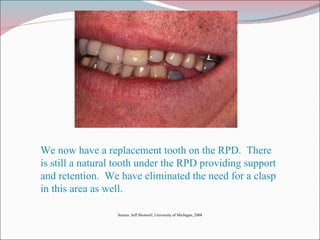 We now have a replacement tooth on the RPD.  There is still a natural tooth under the RPD providing support and retention.  We have eliminated the need for a clasp in this area as well. Source: Jeff Shotwell, University of Michigan, 2008 
