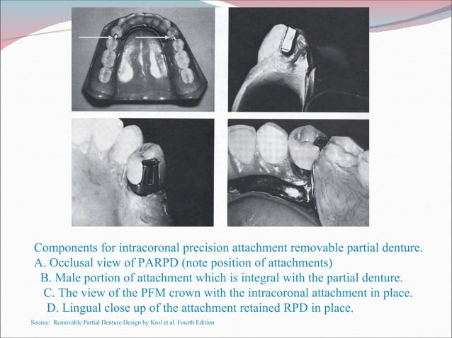 Palatable Strap Rpd Attachments & their use in rpd fabrication | PPT