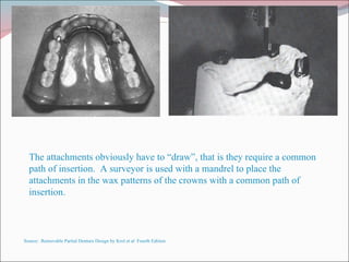 The attachments obviously have to “draw”, that is they require a common path of insertion.  A surveyor is used with a mandrel to place the attachments in the wax patterns of the crowns with a common path of insertion. Source:  Removable Partial Denture Design by Krol et al  Fourth Edition 