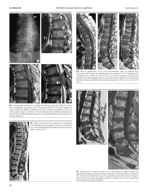 31-192-D-10 Atteintes osseuses dans le myélome Radiodiagnostic 
*A 
*B 
*C *D 
18 Radiographie standard (A) : ostéolyse du pédicule gauche de T8 (flèche) et mau-vaise 
visualisation du pédicule droit. On note par ailleurs un tassement modéré du 
corps vertébral. En IRM en pondération T1 (B, C) comme en pondération T2 (D), on 
note un aspect de type « poivre et sel » de la moelle osseuse des vertèbres explorées ainsi 
qu’une lésion nodulaire du pédicule gauche et une atteinte épidurale bien visualisée sur 
les deux séquences. 
19 IRM en pondération T2 : myélome sous traitement 
(chimiothérapie puis autogreffe). On note une évolution 
vers un aspect hétérogène de la moelle osseuse qui perd son 
aspect « poivre et sel ». 
*A *B *C 
20 IRM en pondération T1 du rachis dorsolombaire. Mise en évidence d’un 
tassement d’aspect malin avec bombement du mur postérieur en T7 et hyposignal de 
l’ensemble de la vertèbre (A). En L1 et L2, on note des tassements de type ostéo-porotique 
avec bande d’hyposignal au contact du plateau inférieur. On retrouve par 
ailleurs des lésions nodulaires disséminées notamment en T11, L1, L2, L3, L4 et S1 
(B, C). 
21 IRM à j0 (A) : on note au niveau L4 et L5 des tassements d’allure bénigne avec 
hyposignal en bande au contact du plateau supérieur (à noter par ailleurs une lésion en 
S1). À j+4 mois (B) la moelle osseuse de L4 apparaît normale, alors qu’en L5 l’hyposi-gnal 
en bande au contact du plateau supérieur a disparu mais on note l’apparition 
d’une lésion du coin antéro-inférieur. 
*A 
*B 
10 
 