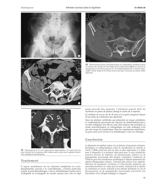 Radiodiagnostic Atteintes osseuses dans le myélome 31-192-D-10 
Traitement 
Il repose actuellement sur les alkylants (melphalan ou cyclo-phosphamide) 
associés à la corticothérapie ; d’autres protocoles 
comme la polychimiothérapie, voire la chimiothérapie lourde suivie 
d’allogreffe ou d’autogreffe de moelle osseuse (ceci chez le sujet 
24 Plasmocytome localisé à l’aile iliaque droite. Les radiographies standards mettent 
en évidence une ostéolyse de l’aile iliaque droite d’appréciation difficile en raison de la 
superposition de structures gazeuses (A). La tomodensitométrie (B, C) montre l’aspect 
soufflé et même rompu de la corticale osseuse ainsi que l’extension aux parties molles 
adjacentes. 
jeune) peuvent être proposés. L’interféron prescrit dans les 
myélomes en phase de plateau allonge la durée de la réponse. 
La médiane de survie est de 30 mois et n’a guère progressé depuis 
20 ans (date de l’utilisation des alkylants). 
Dans les atteintes vertébrales qui présentent un risque médullaire, 
la vertébroplastie percutanée par injection de méthylméthacrylate a 
un effet antalgique très efficace mais doit toujours être pratiquée en 
centre neurochirurgical ou orthopédique car cette technique n’est 
pas sans risque de complication. Dans les compressions médullaires, 
on peut aussi avoir recours à la radiothérapie, voire à la chirurgie. 
Conclusion 
Le diagnostic de myélome repose sur un faisceau d’arguments cliniques, 
biologiques et radiographiques selon la classification de Salmon et 
Durie. L’IRM prend une part de plus en plus importante à ce bilan 
pour le diagnostic et le pronostic mais aussi pour le suivi évolutif des 
patients atteints de myélome, de plasmocytome solitaire ou de 
gammapathie monoclonale dite bénigne. Cependant, l’indication de 
l’IRM ne peut être actuellement systématique et dépend notamment des 
options thérapeutiques choisies : extension plus précise d’un myélome, 
détection de tassements vertébraux et d’éventuelles épidurites qui 
pourraient présenter un risque pour la moelle, évaluation de la réponse 
au traitement ou encore recherche d’une atteinte disséminée en cas de 
plasmocytome ou de gammapathie monoclonale présentant une 
discordance entre clinique biologique et imagerie. 
*A 
*B 
*C 
25 Plasmocytome de L5 avec trabéculations hypertrophiées. Cet aspect peut être 
aussi retrouvé sur les séquences IRM réalisées dans le plan axial et apparaît relative-ment 
spécifique du plasmocytome. 
13 
 