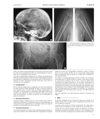 Radiodiagnostic Atteintes osseuses dans le myélome 31-192-D-10 
*A *B *C 
Enfin, des lésions ostéocondensantes peuvent être retrouvées dans 
les suites d’un traitement par radio- ou chimiothérapie ou dans le 
cadre de la consolidation d’une fracture. 
Au total, la radiographie standard est un élément fondamental du 
bilan de myélome puisque l’atteinte osseuse radiologique fait partie 
des éléments du diagnostic et du pronostic selon la classification de 
Salmon et Durie. Rappelons qu’elle intervient aussi dans la 
surveillance sous traitement. 
¦ Scintigraphie [1, 27] 
Elle est très peu utilisée dans le diagnostic et le suivi des myélomes 
en raison d’une très faible sensibilité. En effet, il existe de nombreux 
faux négatifs liés à la petite taille des lésions ostéolytiques. En 
revanche, la scintigraphie au technétium 99m-MIBI semble plus 
sensible pour détecter les lésions du myélome mais aussi pour le 
suivi sous traitement : en effet, on observe une normalisation en 
phase de rémission. 
¦ Ostéodensitométrie [29] 
Certaines équipes l’utilisent dans le suivi évolutif. Sous l’effet du 
traitement, notamment le clodronate associé à la chimiothérapie, on 
peut observer une augmentation de la densité osseuse qui apparaît 
corrélée à la diminution de la masse tumorale. 
¦ Tomodensitométrie [2, 3] 
La tomodensitométrie ne doit pas être systématiquement réalisée au 
cours d’un myélome. Son intérêt réside dans l’exploration de régions 
1 Aspect microlacunaire très typique au niveau du crâne 
(A). Au niveau des humérus et du bassin les lésions sont 
moins nombreuses mais apparaissent à l’emporte-pièce (B, 
C, D). 
*D 
difficiles d’accès aux radiographies standards, comme le bassin 
(fig 9) ou les os plats (fig 10), ou en cas de doute diagnostique 
(fig 11) (cependant, dans ce dernier cas, l’IRM tend à remplacer la 
tomodensitométrie). 
Par ailleurs, la tomodensitométrie permet un bilan de l’extension 
éventuelle dans les parties molles au contact d’une lésion osseuse 
ou extraosseuse primitive (fig 12). Elle a aussi un intérêt dans 
l’évaluation du risque fracturaire en cas de lésion ostéolytique en 
visualisant particulièrement bien les corticales osseuses et les 
déplacements éventuels. La tomodensitométrie peut permettre aussi 
un repérage avant une biopsie à visée diagnostique. Associé au bilan 
IRM, le prélèvement peut permettre de rechercher des anomalies 
cytogénétiques de façon plus précise que par un prélèvement en 
crête iliaque. 
Elle voit cependant son intérêt diminuer depuis l’avènement de 
l’IRM. 
¦ IRM [4, 6, 11, 12, 17, 18, 19, 20, 22, 23, 24, 25, 30, 31] 
Sa grande sensibilité en fait l’examen de choix pour l’étude de la 
moelle osseuse. Elle a sa place dans le diagnostic, le pronostic et le 
suivi évolutif du myélome. 
L’examen peut comporter l’étude systématique du rachis dorso-lombo- 
sacré et du bassin et/ou être centré sur un site douloureux. 
L’étude de l’axe pelvirachidien permet la détection de lésions 
cliniquement muettes susceptibles de menacer l’axe médullaire, mais 
aussi des anomalies de signal pour certaines assez caractéristiques. 
3 
 