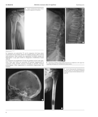 31-192-D-10 Atteintes osseuses dans le myélome Radiodiagnostic 
2 Aspect vermoulu de la trame osseuse 
de la partie moyenne de l’humérus. 
Séquences [11, 23] 
La séquence en spin-écho T1 est la séquence de base pour 
l’exploration de la moelle osseuse de l’adulte puisque celle-ci est de 
type graisseux. Dans certains cas, cependant, la moelle osseuse est 
hétérogène ce qui peut rendre le diagnostic d’infiltration focale 
difficile. 
Les séquences en pondération T2 écho de gradient ou fast turbo spin-écho, 
ainsi que celles en saturation de graisse augmentent le 
contraste entre moelle osseuse normale et moelle osseuse 
pathologique. Elles augmentent la sensibilité diagnostique des 
nodules. 
4 Tassements vertébraux étagés d’allure biconcave ou cunéiforme (A, B). Aspect mi-crogéodique 
hétérogène de l’ensemble de la trame osseuse. 
3 Lacunes beaucoup plus volumineuses au 
niveau du crâne (A). Au niveau de l’humérus 
on note une érosion du bord endostal de la cor-ticale 
(B). 
*A 
*B 
*A 
*B 
4 
 