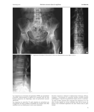 Radiodiagnostic Atteintes osseuses dans le myélome 31-192-D-10 
*A *B 
5 Myélomatose décalcifiante deWeissenbach et Lièvre avec déminéralisation osseuse diffuse (A, B, C). 
Les séquences en inversion récupération (STIR) qui permettent 
d’annuler sélectivement le signal de la graisse sont de très 
bonnes séquences de dépistage, mais ne présentent aucune 
spécificité. 
Les séquences en spin-écho T1 après injection ne permettent pas 
d’augmenter de façon notable la sensibilité de l’examen mais elles 
semblent avoir un intérêt pour le suivi sous traitement. 
D’autres séquences utilisant le déplacement chimique (Dixon, 
Chopper...) accentuent le contraste moelle normale/moelle 
pathologique. L’injection de gadolinium majore encore ce contraste. 
Au total, le bilan minimal doit comporter des séquences T1 et T2 
dans le plan sagittal au niveau rachidien ainsi qu’au niveau du 
bassin et de l’extrémité supérieure des deux fémurs dans le plan 
frontal. 
*C 
5 
 