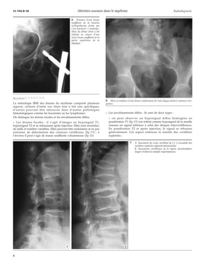 31-192-D-10 Atteintes osseuses dans le myélome Radiodiagnostic 
Résultats [6, 17, 18, 20, 23, 24, 30] 
La sémiologie IRM des lésions du myélome comporte plusieurs 
aspects, certains d’entre eux étant tout à fait non spécifiques, 
d’autres pouvant être retrouvés dans d’autres pathologies 
hématologiques comme les leucémies ou les lymphomes. 
On distingue les lésions focales et les envahissements diffus. 
– Les lésions focales : il s’agit d’images en hyposignal T1, 
hypersignal T2 et se rehaussant après injection. Elles sont arrondies, 
de taille et nombre variables. Elles peuvent être nodulaires et ne pas 
entraîner de déformation des contours vertébraux (fig 13) ; à 
l’inverse il peut s’agir de masse soufflante volumineuse (fig 14). 
8 Mise en évidence d’une lésion condensante de l’aile iliaque droite à contours irré-guliers. 
– Les envahissements diffus : ils sont de deux types : 
– on peut observer un hyposignal diffus homogène en 
pondération T1 (fig 15) (on retient comme hyposignal de la moelle 
osseuse un signal inférieur à celui des disques intervertébraux). 
En pondération T2 et après injection, le signal se rehausse 
généralement. Cet aspect intéresse la totalité des vertèbres 
explorées ; 
6 Présence d’une lésion 
soufflante de la branche 
ischiopubienne droite qui 
s’est fracturée. L’ostéosyn-thèse 
du fémur droit a été 
réalisée en raison d’une 
autre lésion soufflante de la 
partie supérieure de la 
diaphyse. 
7 A. Tassement du corps vertébral de L2. L’ensemble des 
vertèbres explorées apparaît déminéralisé. 
B. Tassements vertébraux de la région dorsolombaire 
étagée révélant la maladie myélomateuse. 
*A *B 
6 
 