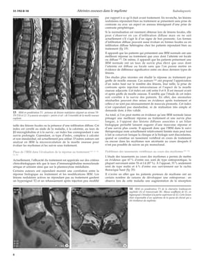 31-192-D-10 Atteintes osseuses dans le myélome Radiodiagnostic 
taille des lésions focales ou la présence d’une infiltration diffuse. Cet 
index est corrélé au stade de la maladie, à la calcémie, au taux de 
b2-microglobuline et à la survie ; un index bas correspondant à une 
survie prolongée. Cependant, ce type d’index, complexe à calculer 
et non standardisé, est actuellement peu utilisé. D’autres auteurs ont 
analysé en IRM la microcirculation de la moelle osseuse pour 
évaluer les myélomes et les suivre sous traitement. 
Place de l’IRM dans l’évaluation de la réponse au traitement [14, 17, 21, 
24, 26] 
Actuellement, l’efficacité du traitement est appréciée sur des critères 
clinicobiologiques tels que le taux d’immunoglobuline monoclonale 
sérique et urinaire ainsi que sur la plasmocytose médullaire. 
Certains auteurs ont cependant montré une corrélation entre la 
réponse biologique au traitement et les modifications IRM. Les 
lésions nodulaires actives ne répondant pas au traitement gardent 
un hypersignal T2 et un rehaussement après injection peu modifié 
par rapport à ce qu’il était avant traitement. En revanche, les lésions 
nodulaires répondant bien au traitement se présentent sans prise de 
contraste ou avec un aspect en anneau témoignant d’une prise de 
contraste périphérique. 
Si la normalisation est rarement obtenue lors de lésions focales, elle 
peut s’observer en cas d’infiltration diffuse mais on ne sait 
actuellement s’il s’agit là d’un signe de bon pronostic. Les formes 
d’infiltration diffuse peuvent aussi évoluer en formes focales ou en 
infiltration diffuse hétérogène chez les patients répondant bien au 
traitement (fig 19). 
Il apparaît que les patients qui présentent une IRM normale ont une 
meilleure réponse au traitement que ceux dont l’atteinte est focale 
ou diffuse [17]. De même, il apparaît que les patients présentant une 
IRM normale ont un taux de survie plus élevé que ceux dont 
l’atteinte est diffuse ou focale sans que l’on puisse mettre en 
évidence de différence significative entre ces deux derniers types de 
lésions. 
Des études plus récentes ont étudié la réponse au traitement par 
greffe de moelle osseuse. Ces auteurs [14] ont proposé l’appréciation 
d’un index basé sur le nombre des lésions, leur taille, la prise de 
contraste après injection intraveineuse et l’aspect de la moelle 
osseuse adjacente. Cet index est coté entre 0 et 8. Il est mesuré avant 
et après greffe de moelle osseuse. Il semble que l’étude de cet index 
soit corrélée à la survie des patients. En effet, des anomalies 
résiduelles peuvent être mises en évidence après traitement et 
celles-ci ne sont pas nécessairement de mauvais pronostic. Cet index 
n’est cependant pas standardisé, ni de réalisation très simple et 
demande donc à être validé. 
Au total, si l’on peut mettre en évidence qu’une IRM normale laisse 
présager une meilleure réponse au traitement et une survie plus 
longue, à l’opposé des lésions diffuses associées à un bilan 
biologique perturbé laissent augurer d’une mauvaise réponse et 
d’une survie plus courte. Il apparaît donc que l’IRM dans le suivi 
thérapeutique reste actuellement relativement limitée mais peut tout 
à fait se concevoir lorsque la clinique et la biologie sont discordantes, 
quand se constitue un tassement vertébral en cours de traitement 
ou encore dans les myélomes non sécrétants au cours desquels il 
n’est pas possible de suivre un pic monoclonal. 
Problèmes des tassements vertébraux au cours des myélomes [15, 16] 
L’étude des tassements au cours des myélomes a permis de mettre 
en évidence que 67 % d’entre eux sont de type ostéoporotique, la 
plupart survenant entre T6 et L4 (87 %). À l’opposé, 33 % seulement 
sont de type malin et 4 % d’entre eux surviennent sur le rachis 
thoracique haut (fig 20). 
Il s’avère en effet que les patients porteurs de myélome ont un 
certain nombre de raisons de développer une ostéoporose : on 
observe lors de cette maladie une augmentation de la résorption 
13 IRM en pondération T1 : présence de lésions nodulaires siégeant au niveau T8- 
T9-T10 et L1. S’y associe un aspect « poivre et sel » de l’ensemble de la moelle osseuse 
explorée. 
14 IRM en pondération T1 de la charnière lombosacrée 
sagittale (A) et transversale (B). Masse soufflante de S1, en 
hyposignal s’étendant à la partie supérieure de S2. Cette lésion 
était responsable d’un syndrome de la queue-de-cheval qui a 
été révélateur du myélome. 
*A *B 
8 
 