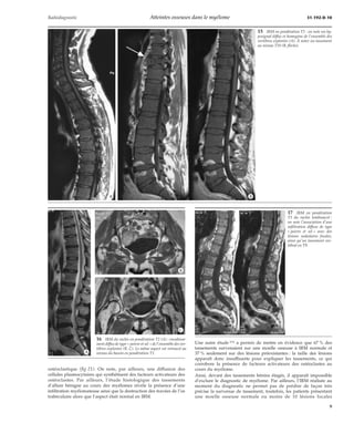 Radiodiagnostic Atteintes osseuses dans le myélome 31-192-D-10 
*A *B 
ostéoclastique (fig 21). On note, par ailleurs, une diffusion des 
cellules plasmocytaires qui synthétisent des facteurs activateurs des 
ostéoclastes. Par ailleurs, l’étude histologique des tassements 
d’allure bénigne au cours des myélomes révèle la présence d’une 
infiltration myélomateuse ainsi que la destruction des travées de l’os 
trabéculaire alors que l’aspect était normal en IRM. 
15 IRM en pondération T1 : on note un hy-posignal 
diffus et homogène de l’ensemble des 
vertèbres explorées (A). À noter un tassement 
au niveau T10 (B, flèche). 
Une autre étude [15] a permis de mettre en évidence que 67 % des 
tassements survenaient sur une moelle osseuse à IRM normale et 
37 % seulement sur des lésions préexistantes : la taille des lésions 
apparaît donc insuffisante pour expliquer les tassements, ce qui 
corrobore la présence de facteurs activateurs des ostéoclastes au 
cours du myélome. 
Ainsi, devant des tassements bénins étagés, il apparaît impossible 
d’exclure le diagnostic de myélome. Par ailleurs, l’IRM réalisée au 
moment du diagnostic ne permet pas de prédire de façon très 
précise la survenue de tassement, toutefois, les patients présentant 
une moelle osseuse normale ou moins de 10 lésions focales 
16 IRM du rachis en pondération T2 (A) : envahisse-ment 
diffus de type « poivre et sel » de l’ensemble des ver-tèbres 
explorées (B, C). Le même aspect est retrouvé au 
*A niveau du bassin en pondération T1. 
*B 
*C 
17 IRM en pondération 
T1 du rachis lombosacré : 
on note l’association d’une 
infiltration diffuse de type 
« poivre et sel » avec des 
lésions nodulaires focales, 
ainsi qu’un tassement ver-tébral 
en T9. 
9 
 