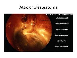 Atticotmy | PPTX