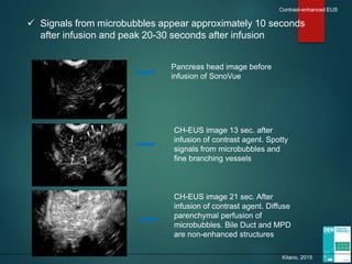  Signals from microbubbles appear approximately 10 seconds
after infusion and peak 20-30 seconds after infusion
Pancreas head image before
infusion of SonoVue
CH-EUS image 13 sec. after
infusion of contrast agent. Spotty
signals from microbubbles and
fine branching vessels
CH-EUS image 21 sec. After
infusion of contrast agent. Diffuse
parenchymal perfusion of
microbubbles. Bile Duct and MPD
are non-enhanced structures
Kitano, 2015
Contrast-enhanced EUS
 