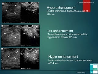Hypo-enhancement
Ductal carcinoma, hypoechoic area of
23 mm
Iso-enhancement
Tumor-forming chroning pancreatitis,
hypoechoic area of 22 mm
Hyper-enhancement
Neuroendocrine tumor, hypoechoic area
of 14 mm
Kitano, 2015
Contrast-enhanced EUS
 