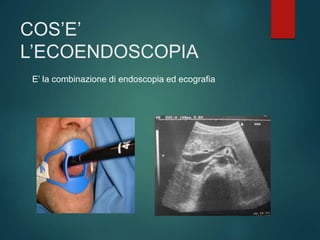 COS’E’
L’ECOENDOSCOPIA
E’ la combinazione di endoscopia ed ecografia
 