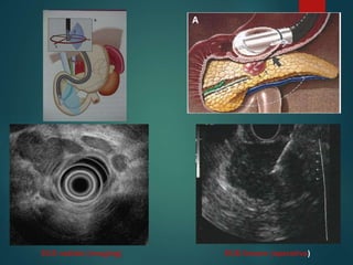 EUS radiale (imaging) EUS lineare (operativa)
 