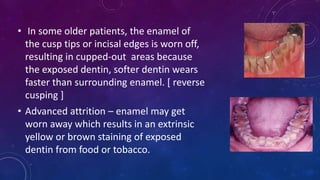 • In some older patients, the enamel of
the cusp tips or incisal edges is worn off,
resulting in cupped-out areas because
the exposed dentin, softer dentin wears
faster than surrounding enamel. [ reverse
cusping ]
• Advanced attrition – enamel may get
worn away which results in an extrinsic
yellow or brown staining of exposed
dentin from food or tobacco.
 