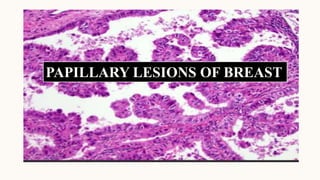 Dealing with ATYPIA and papillary lesions in IN BREAST | PPTX