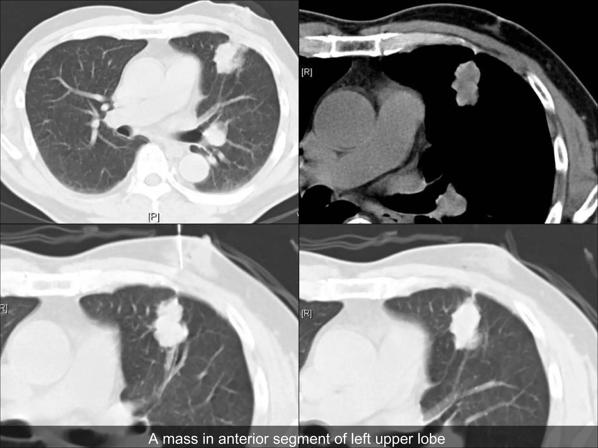 Atypical Carcinoid | PPS