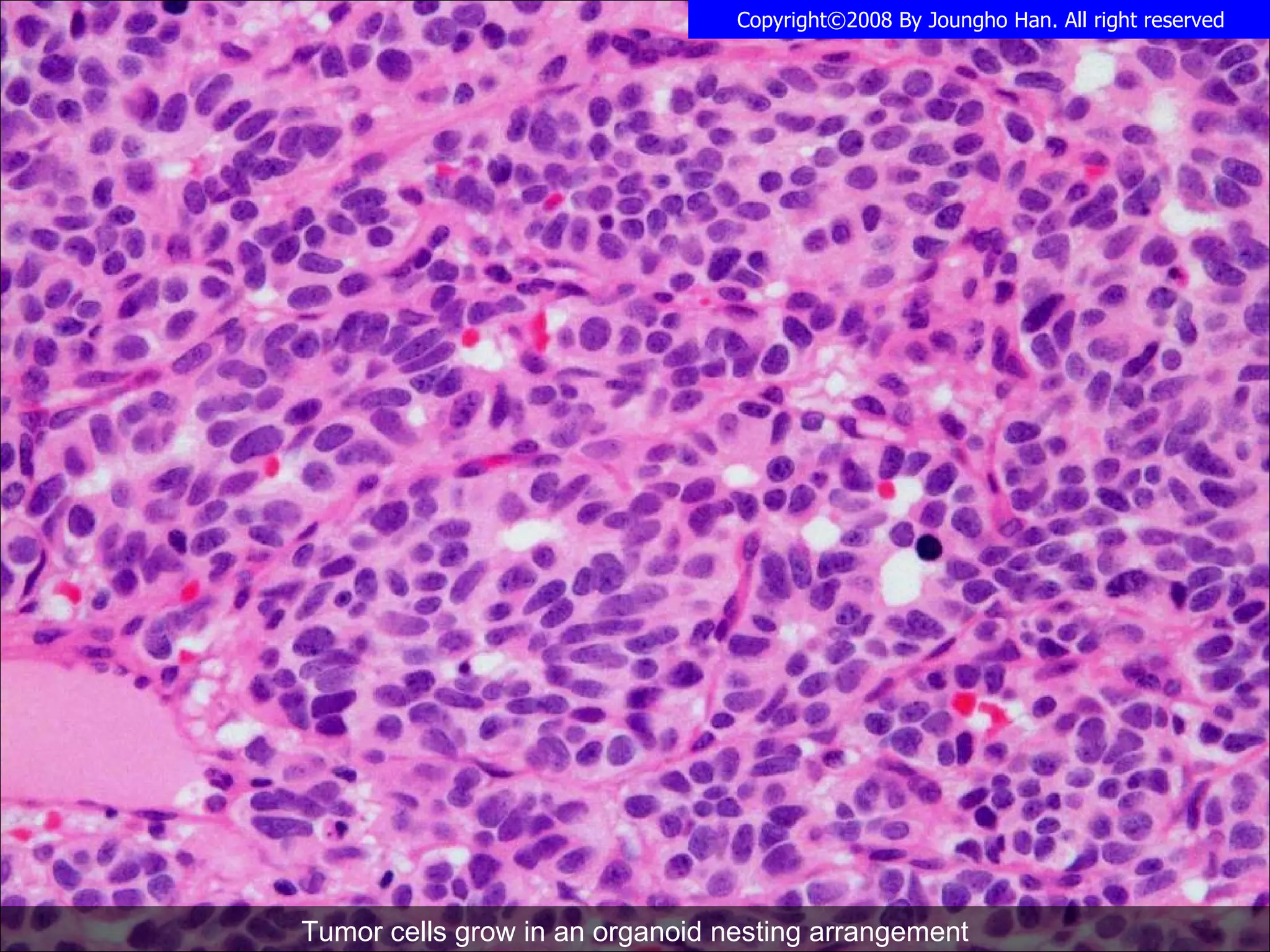 Atypical Carcinoid | PPS