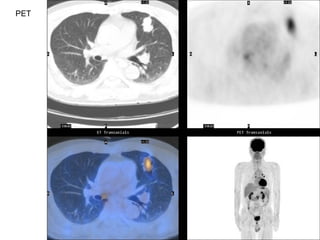 Atypical Carcinoid | PPS