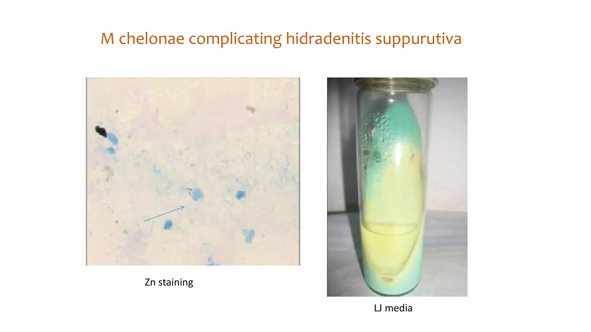 Atypical mycobacterial infections in dermatology | PPTX