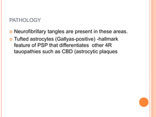 PATHOLOGY
 Neurofibrillary tangles are present in these areas.
 Tufted astrocytes (Gallyas-positive) -hallmark
feature of PSP that differentiates other 4R
tauopathies such as CBD (astrocytic plaques
 