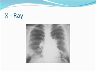 X - Ray 