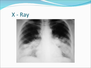 X - Ray 