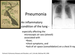 Pneumonia
                               An inflammatory
                               condition of the lung -
                                especially affecting the
                                  microscopic air sacs (alveoli)
                                  associated with
                                   •fever,
                                   •chest symptoms, and
                                   •lack of air space (consolidation) on a chest X-ray

Fishman’s Pulmonary Diseases and Disorders, vol 2, 3rd edn, McGraw Hill, 1996
 