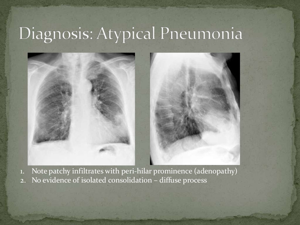 Atypical pneumonia Power Point