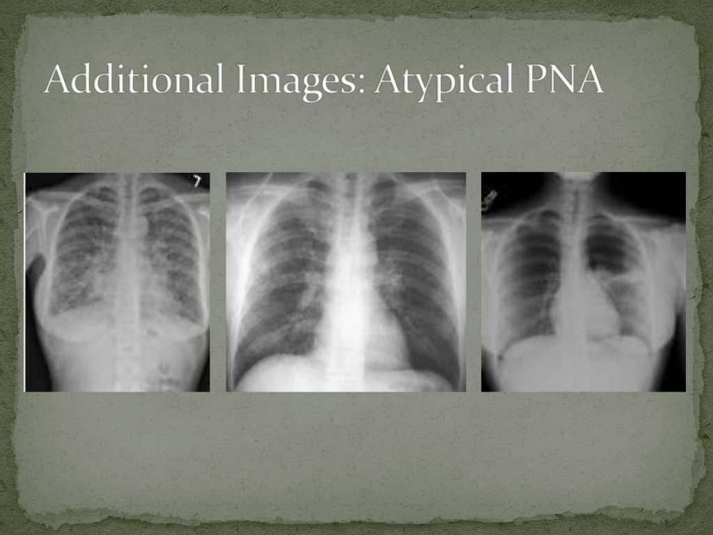 Atypical pneumonia Power Point