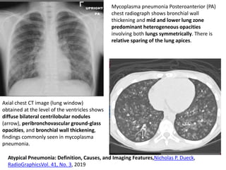 Mycoplasma pneumonia Posteroanterior (PA)
chest radiograph shows bronchial wall
thickening and mid and lower lung zone
predominant heterogeneous opacities
involving both lungs symmetrically. There is
relative sparing of the lung apices.
Axial chest CT image (lung window)
obtained at the level of the ventricles shows
diffuse bilateral centrilobular nodules
(arrow), peribronchovascular ground-glass
opacities, and bronchial wall thickening,
findings commonly seen in mycoplasma
pneumonia.
Atypical Pneumonia: Definition, Causes, and Imaging Features,Nicholas P. Dueck,
RadioGraphicsVol. 41, No. 3, 2019
 