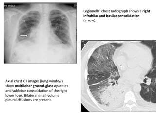 Axial chest CT images (lung window)
show multilobar ground-glass opacities
and sublobar consolidation of the right
lower lobe. Bilateral small-volume
pleural effusions are present.
Legionella: chest radiograph shows a right
infrahilar and basilar consolidation
(arrow).
 