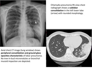 Chlamydia pneumonia-PA view chest
radiograph shows a sublobar
consolidation in the left lower lobe
(arrow) with rounded morphology.
Axial chest CT image (lung window) shows
peripheral consolidation and ground-glass
opacities characteristic of lobar pneumonia.
No tree-in-bud micronodules or bronchial
mucoid impaction are depicted.
 