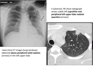 F tularensis: PA chest radiograph
shows subtle left suprahilar and
peripheral left upper lobe nodular
opacities (arrows).
Axial chest CT images (lung windows)
obtained above peripheral solid nodules
(arrows) in the left upper lobe
 