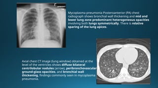 Atypical Pneumonia: Mycoplasma, Chlamydia, and Legionella – Clinical ...