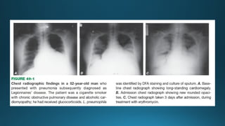 Atypical Pneumonia: Mycoplasma, Chlamydia, and Legionella – Clinical ...
