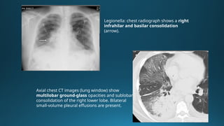Atypical Pneumonia: Mycoplasma, Chlamydia, and Legionella – Clinical ...