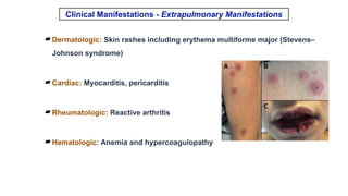 Comprehensive Overview of Atypical Pneumonia and Its Pathogens | PPTX