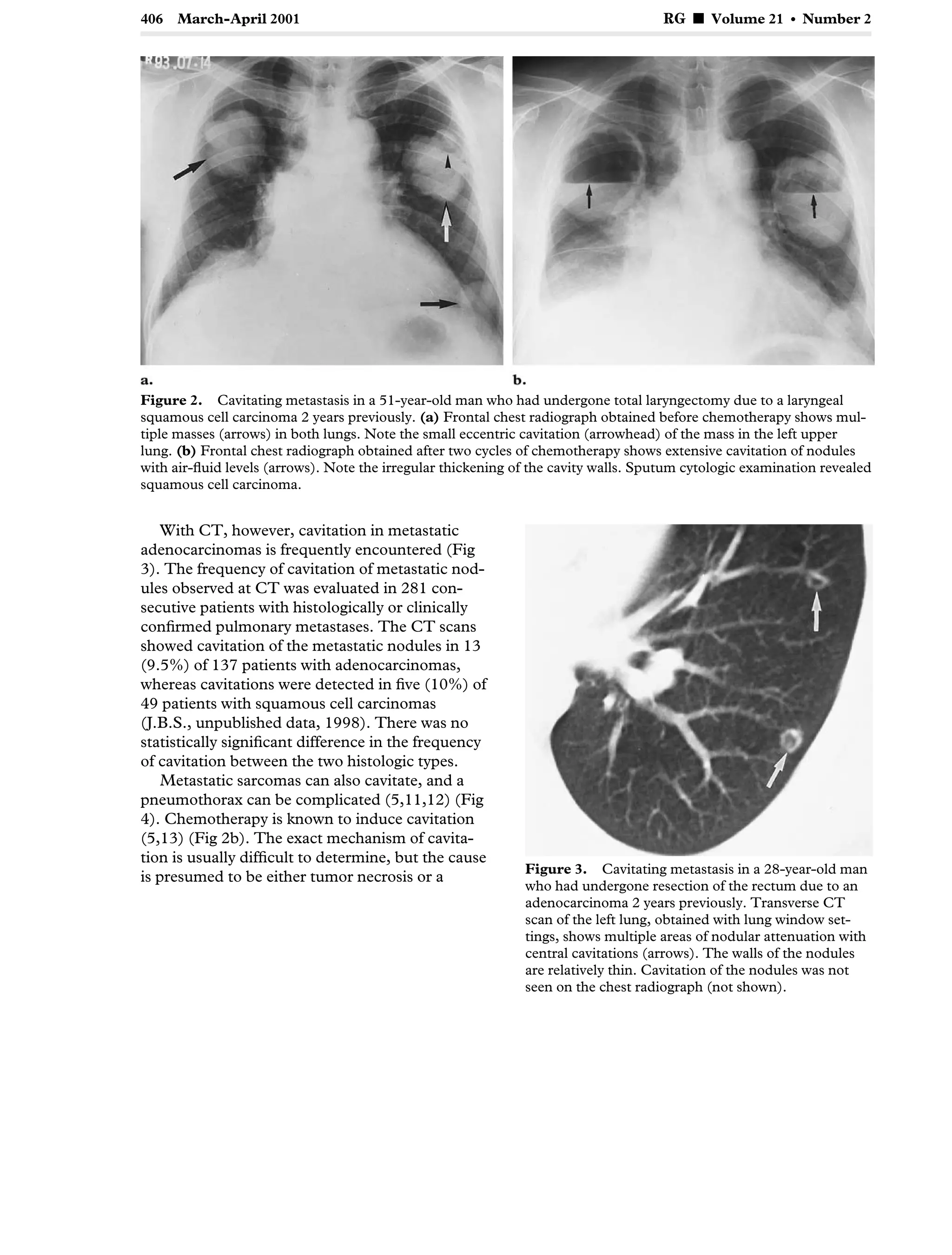 Atypical pulmonary metastases | PDF