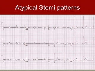 Atypical Stemi patterns
 