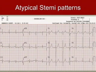 Atypical Stemi patterns
 