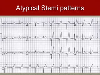 Atypical Stemi patterns
 