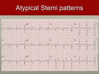 Atypical Stemi patterns
 