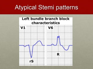 Atypical Stemi patterns
 