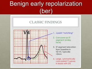 Benign early repolarization
(ber)
 