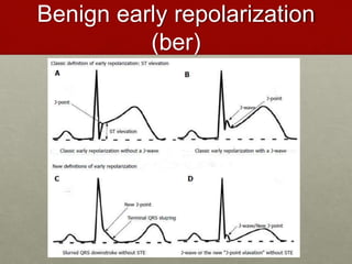 Benign early repolarization
(ber)
 