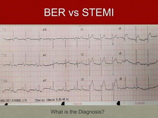 BER vs STEMI
What is the Diagnosis?
 